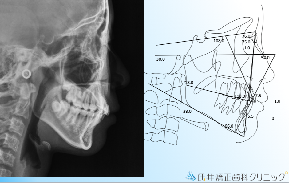 セファロ分析の目的 | 氏井矯正歯科クリニックの豆知識